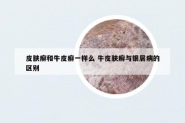 皮膚癬和牛皮癬一樣么 牛皮膚癬與銀屑病的區(qū)別