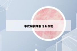 牛皮癬初期有什么表現(xiàn)