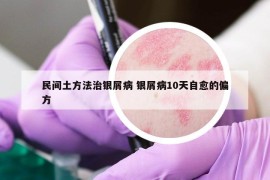 民間土方法治銀屑病 銀屑病10天自愈的偏方