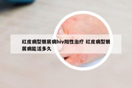 紅皮病型銀屑病hiv陽性治療 紅皮病型銀屑病能活多久