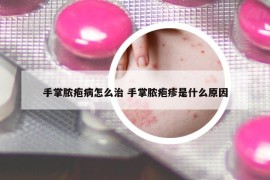 手掌膿皰病怎么治 手掌膿皰疹是什么原因