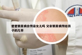 爸爸銀屑病會傳染女兒嗎 父親銀屑病傳給孩子的幾率