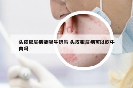 頭皮銀屑病能喝牛奶嗎 頭皮銀屑病可以吃牛肉嗎