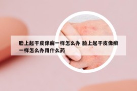 臉上起干皮像癬一樣怎么辦 臉上起干皮像癬一樣怎么辦用什么藥