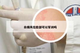 白癜風在臉部可以軍訓嗎