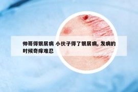 帥哥得銀屑病 小伙子得了銀屑病, 發(fā)病的時候奇癢難忍