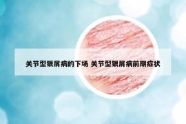 關(guān)節(jié)型銀屑病的下場 關(guān)節(jié)型銀屑病前期癥狀