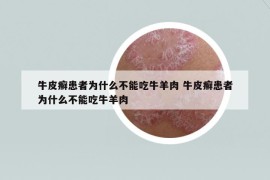 牛皮癬患者為什么不能吃牛羊肉 牛皮癬患者為什么不能吃牛羊肉