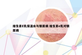 維生素E乳保溫水與銀屑病 維生素e乳對銀屑病