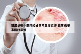 銀屑病哪個(gè)醫(yī)院較好醫(yī)院是哪家好 銀屑病哪家醫(yī)院最好