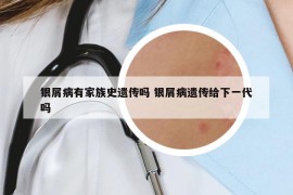 銀屑病有家族史遺傳嗎 銀屑病遺傳給下一代嗎