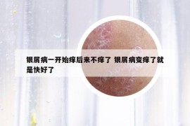 銀屑病一開始癢后來不癢了 銀屑病變癢了就是快好了