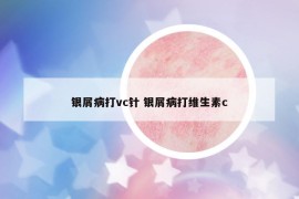 銀屑病打vc針 銀屑病打維生素c