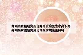 鄭州銀屑病研究所治好牛皮癬復(fù)發(fā)率高不高 鄭州銀屑病研究所治療銀屑病效果好嗎