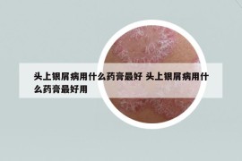 頭上銀屑病用什么藥膏最好 頭上銀屑病用什么藥膏最好用