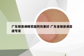 廣東銀屑病哪家醫(yī)院效果好 廣東省銀屑病首席專家