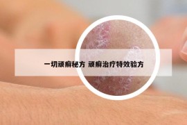 一切頑癬秘方 頑癬治療特效驗(yàn)方