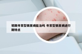 初期尋常型銀屑病能治嗎 尋常型銀屑病進行期特點
