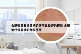 合肥哪里看銀屑病的醫(yī)院比較好的醫(yī)院 合肥治療銀屑病的?？漆t(yī)院