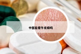 中醫(yī)能看牛皮癬嗎