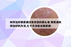 如何治好銀屑病沒有你想的那么難 銀屑病民間治好的方法,七個方法能治銀屑病