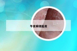 牛皮癬撓起皮
