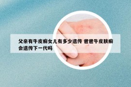 父親有牛皮癬女兒有多少遺傳 爸爸牛皮膚癬會(huì)遺傳下一代嗎