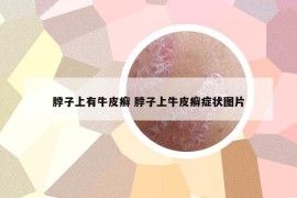 脖子上有牛皮癬 脖子上牛皮癬癥狀圖片