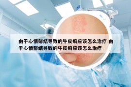 由于心情郁結(jié)導(dǎo)致的牛皮癬應(yīng)該怎么治療 由于心情郁結(jié)導(dǎo)致的牛皮癬應(yīng)該怎么治療