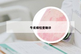 牛皮癬檢查確診
