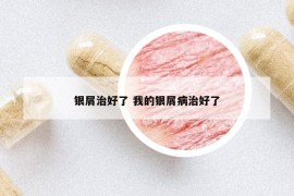 銀屑治好了 我的銀屑病治好了