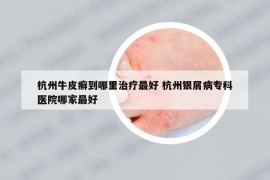 杭州牛皮癬到哪里治療最好 杭州銀屑病?？漆t(yī)院哪家最好