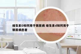 維生素D如何用于銀屑病 維生素d如何用于銀屑病患者