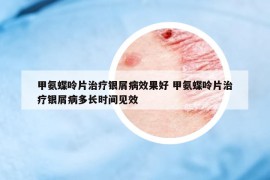 甲氨蝶呤片治療銀屑病效果好 甲氨蝶呤片治療銀屑病多長時(shí)間見效