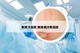 銀屑冷凝膠 銀屑病冷敷凝膠