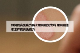 如何提高免疫力防止銀屑病復發(fā)嗎 銀屑病患者怎樣提高免疫力