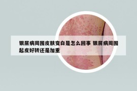 銀屑病周圍皮膚變白是怎么回事 銀屑病周圍起皮好轉(zhuǎn)還是加重