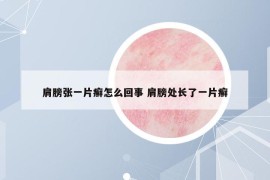 肩膀張一片癬怎么回事 肩膀處長了一片癬