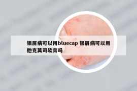 銀屑病可以用bluecap 銀屑病可以用他克莫司軟膏嗎