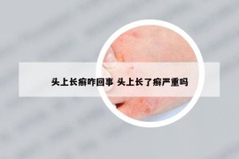 頭上長癬咋回事 頭上長了癬嚴(yán)重嗎