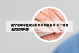 南寧市哪家醫(yī)院治療銀屑病最有效 南寧哪里治皮膚病厲害