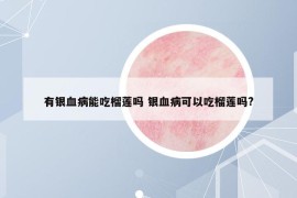 有銀血病能吃榴蓮嗎 銀血病可以吃榴蓮嗎?