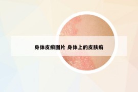 身體皮癬圖片 身體上的皮膚癬