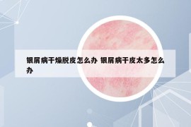 銀屑病干燥脫皮怎么辦 銀屑病干皮太多怎么辦