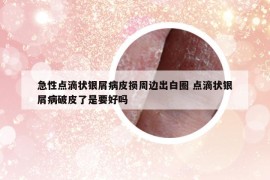 急性點(diǎn)滴狀銀屑病皮損周邊出白圈 點(diǎn)滴狀銀屑病破皮了是要好嗎