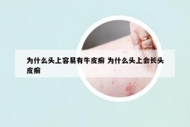 為什么頭上容易有牛皮癬 為什么頭上會(huì)長(zhǎng)頭皮癬