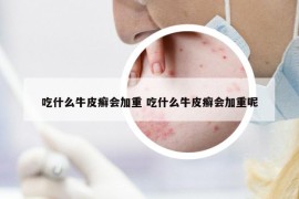 吃什么牛皮癬會加重 吃什么牛皮癬會加重呢