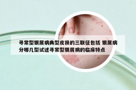 尋常型銀屑病典型皮損的三聯(lián)征包括 銀屑病分哪幾型試述尋常型銀屑病的臨床特點