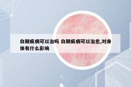 白顛瘋病可以治嗎 白顛瘋病可以治愈,對(duì)身體有什么影響