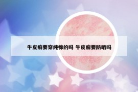牛皮癬要穿純棉的嗎 牛皮癬要防曬嗎